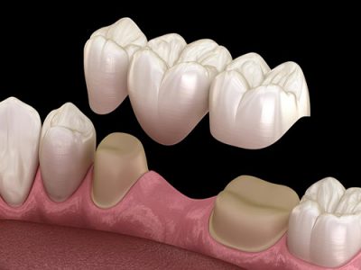 Dental bridge of 3 teeth over molar and premolar. Medically accu
